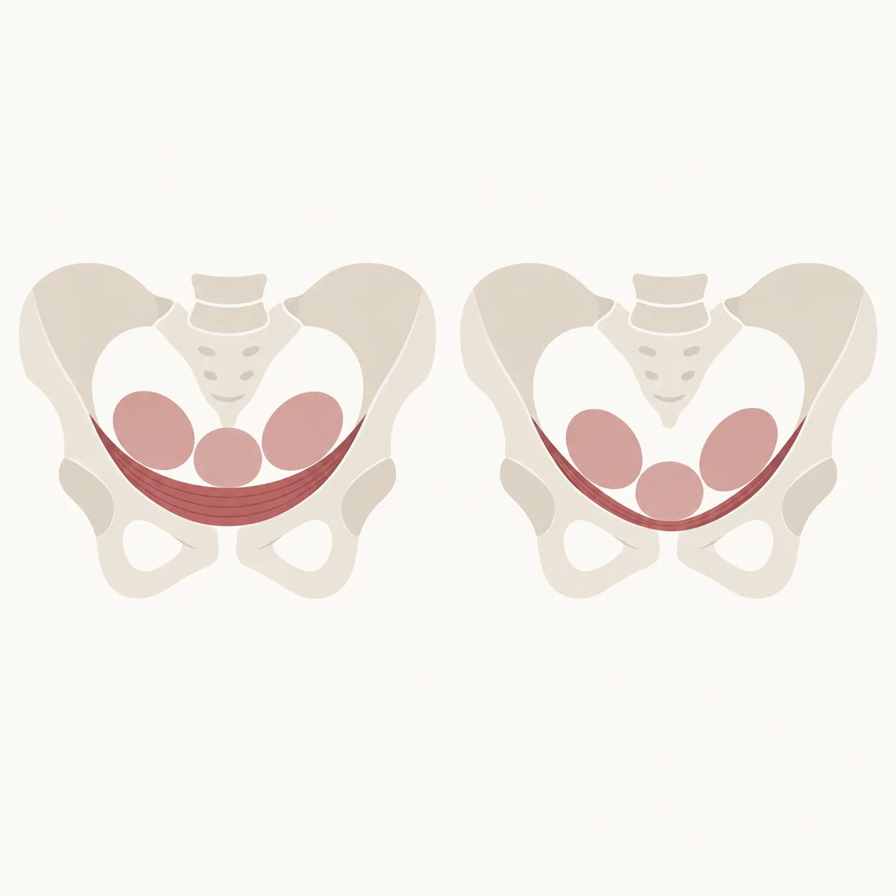 Educational diagram, not a real patient. Two simplified views of the pelvis side by side: on the left the pelvic floor muscle is drawn as a taut band holding three organs in place, on the right the band is drawn slack and lower, with the organs sitting lower.